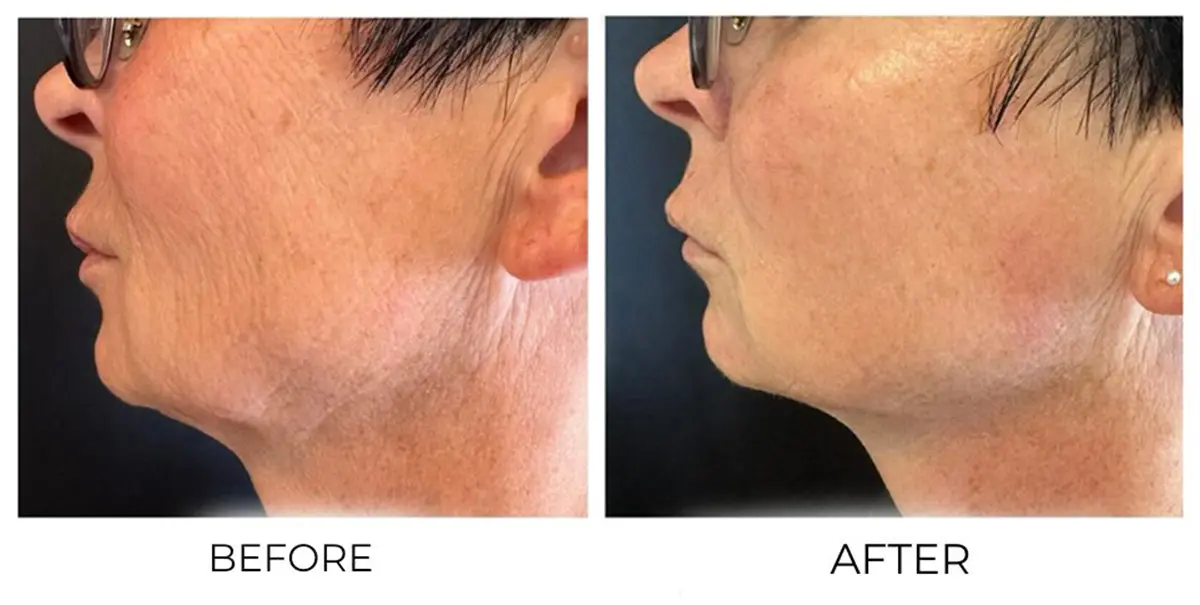 Face & Neck T-Shape Facial results — iCRYO Grosse Pointe