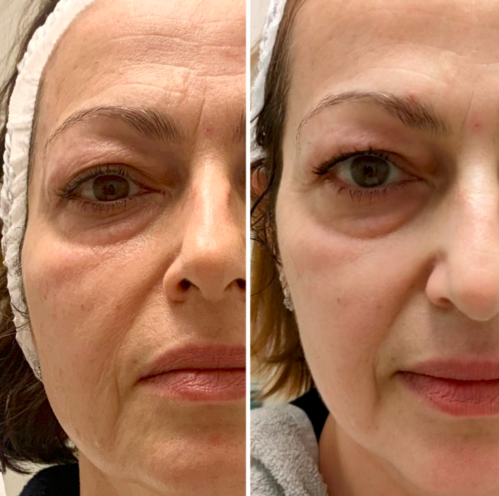 Eye & Cheek Area T-Shape Facial results — iCRYO Grosse Pointe