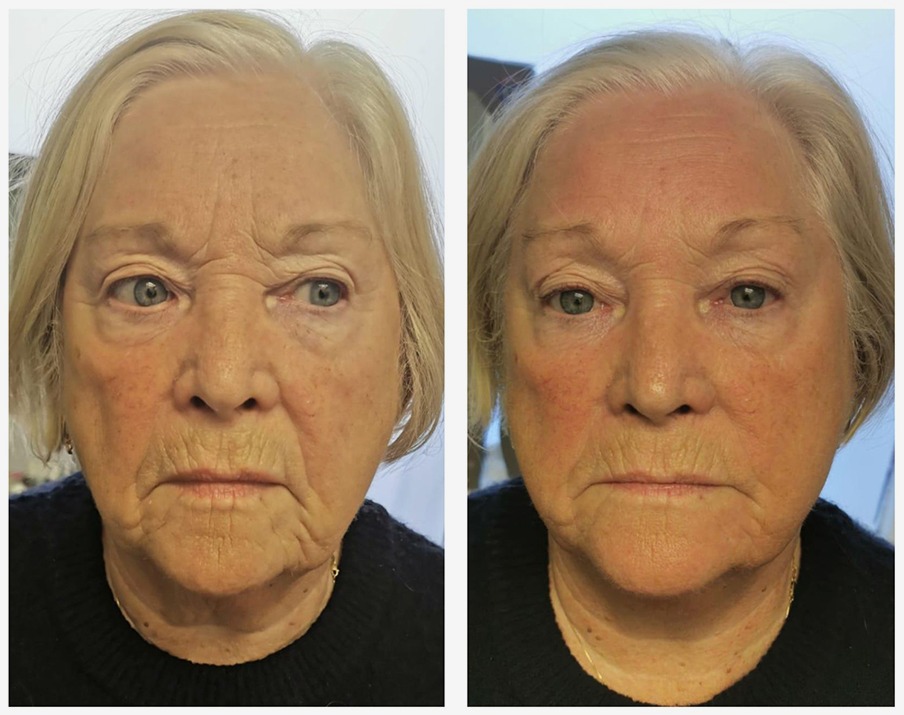 Full Face T-Shape Facial results — iCRYO Grosse Pointe