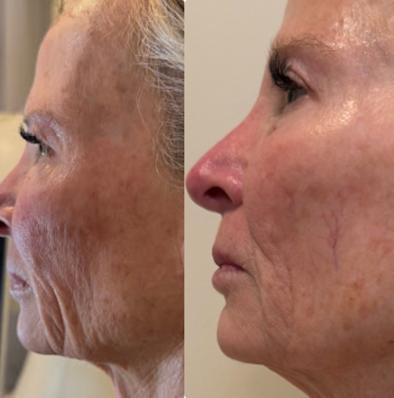 Face & Jawline T-Shape Facial results — iCRYO Grosse Pointe